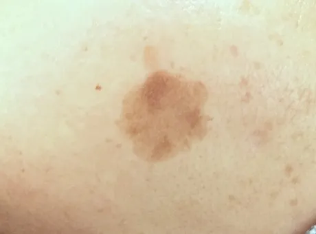 シミって何?種類と原因を徹底解説